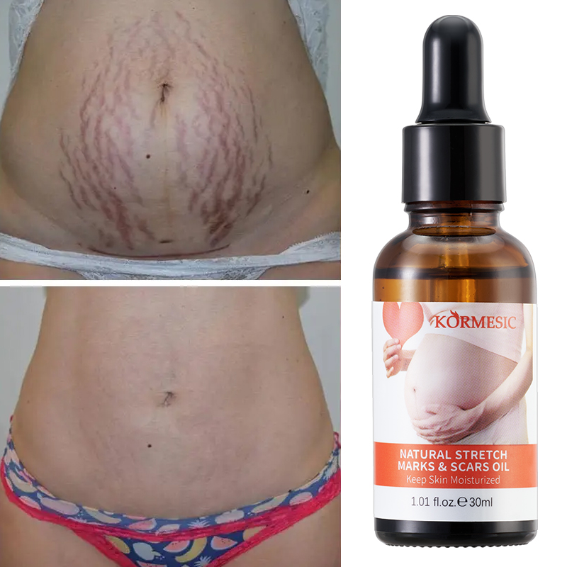 Tinh dầu trị rạn da KORMESIC 30ml