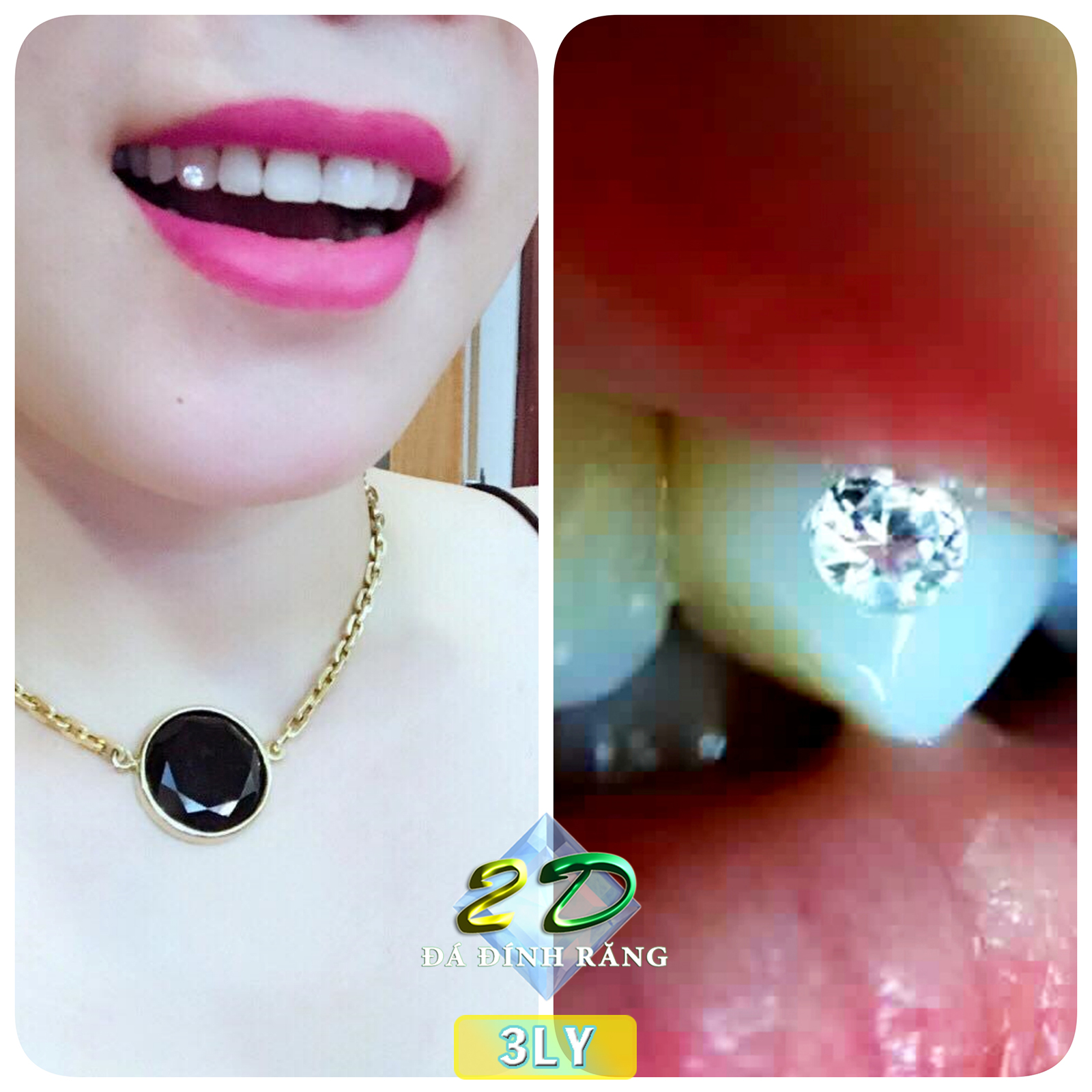 [HCM]Mua 1 tặng 1 -Đá đính răng Thụy Sĩ 3LY (loại lớn)