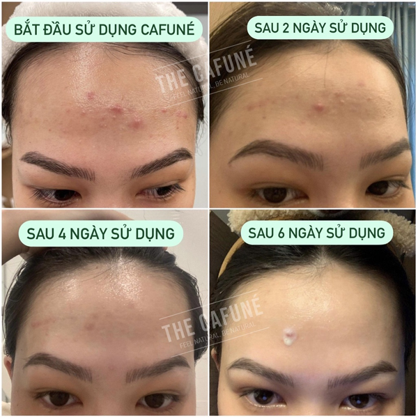 Gel Giảm Mụn Và Thâm Cafuné Essence 15gram