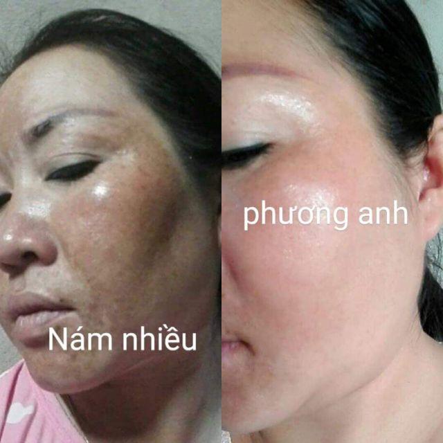 [HCM] Tái Tạo Da Phương Anh