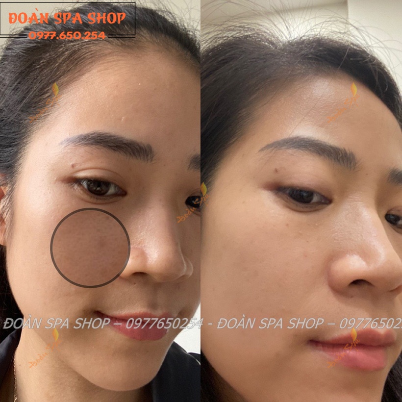 Bộ Phân Hủy Nám Luxury DevaCell - Deva cell