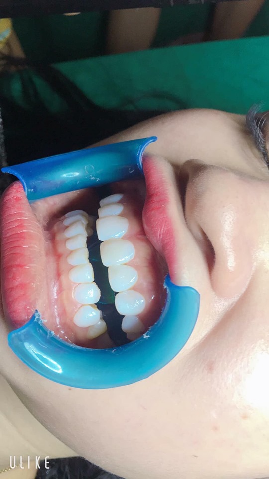 đèn chiếu đính đá răng+phủ răng sứ 99s ánh sáng mạnh x5