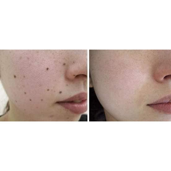 Làm hết Mụn cóc, mụn ruồi Nga