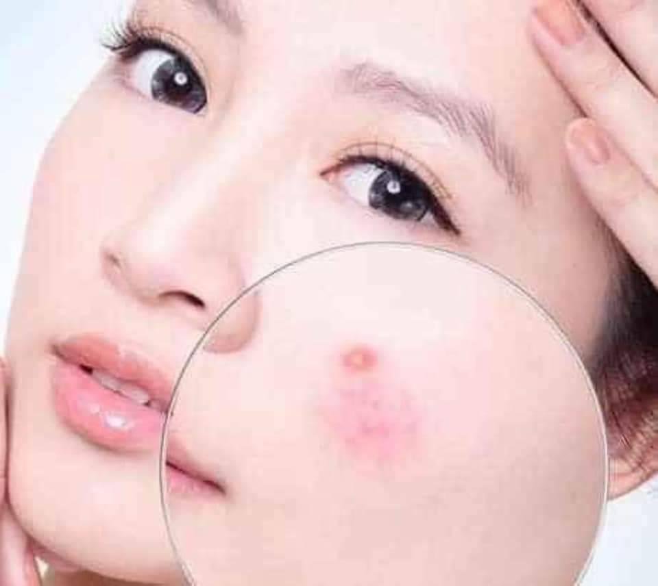 Gel Nha Đam Chấm Mụn Dr Cell 15ml giảm mụn gom còi mụn nhanh chóng
