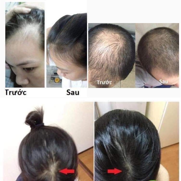 [CHÍNH HÃNG] Tinh Dầu Bưởi Kích Thích Mọc Tóc Vi Jully - Thoitrangtocnhuom