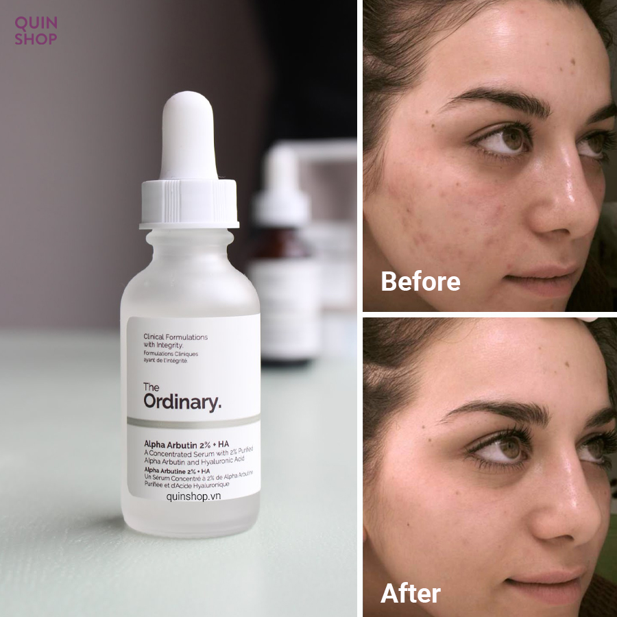 Tinh Chất Dưỡng Sáng Da The Ordinary Alpha Arbutin 2% + HA