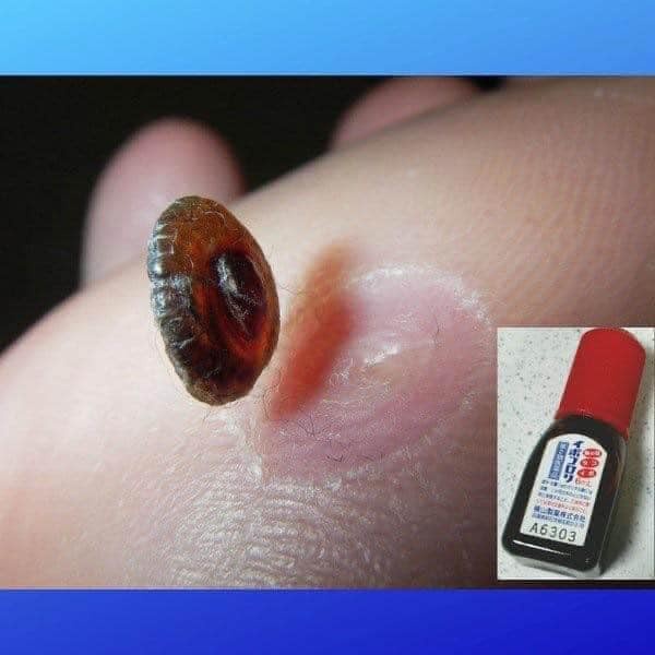 Tinh chất bôi mụn cóc Ibokorori Nhật Bản 10ml