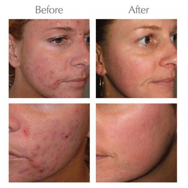 Kem Opera Australia Anti Acnes