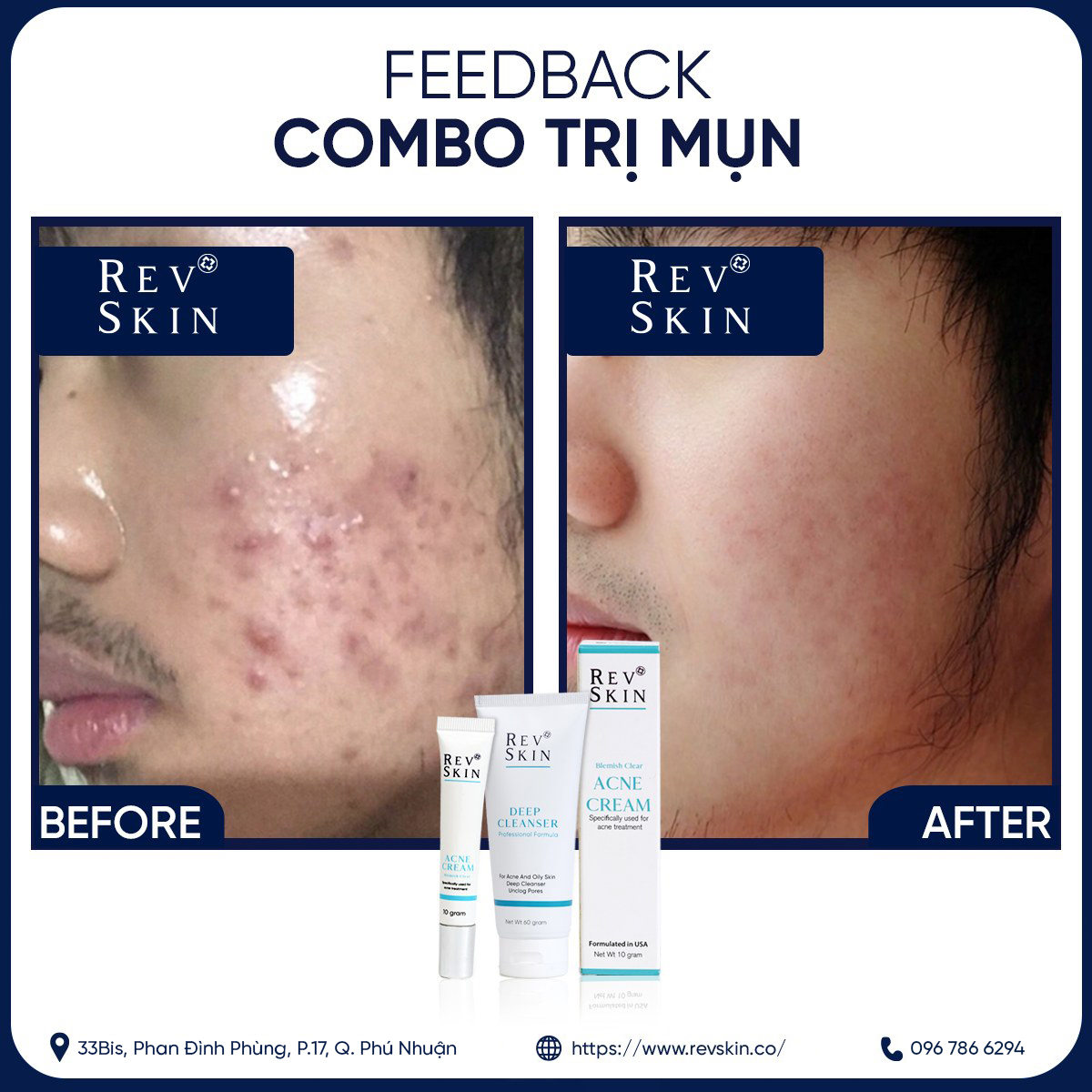 Combo Sạch Mụn RevSkin - Sữa Rửa Mặt + Kem Chấm Mụn