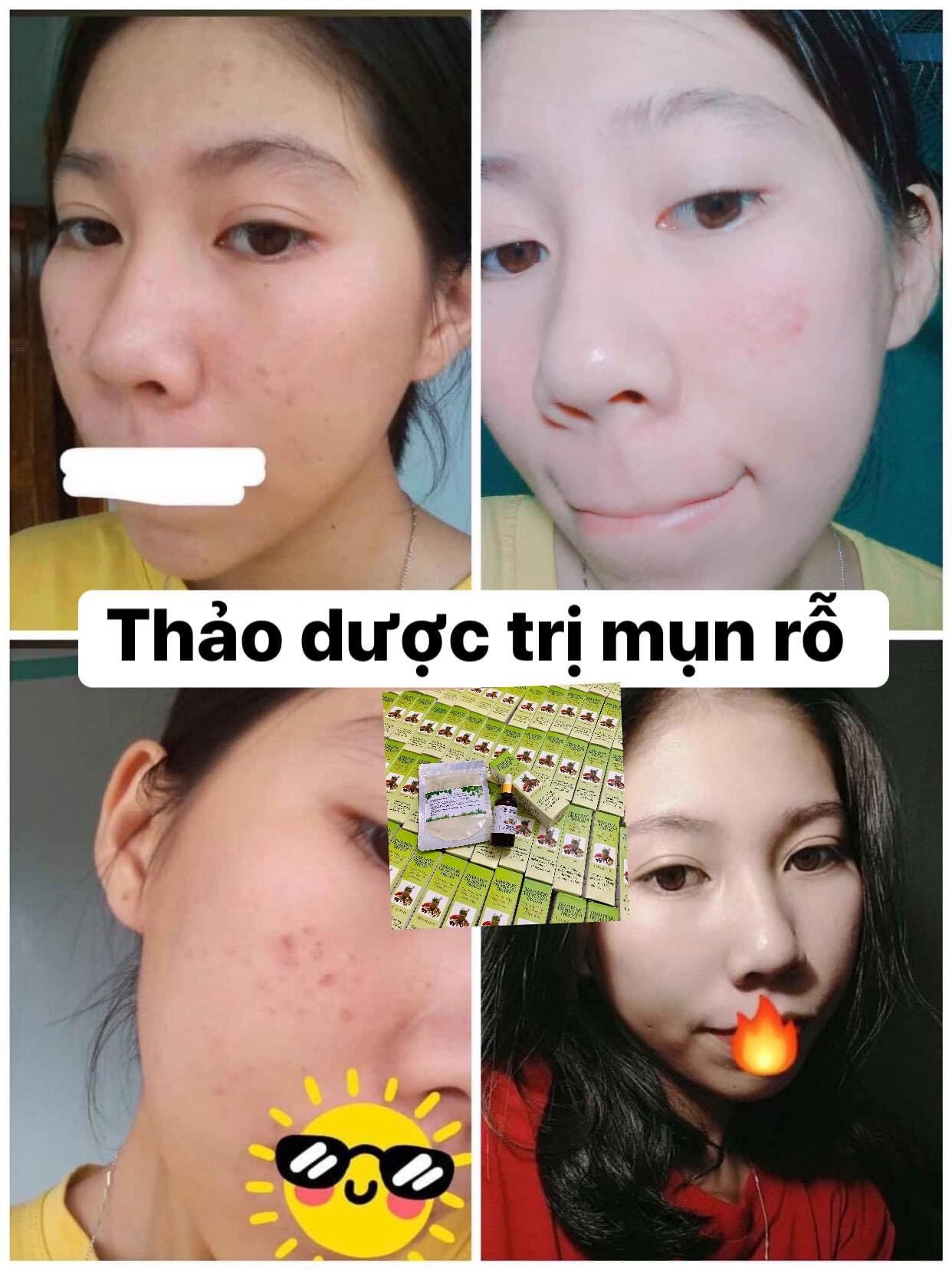 ( 2 lọ )Thảo Dược Sạch Mụn Thâm Rỗ MT (50ml)