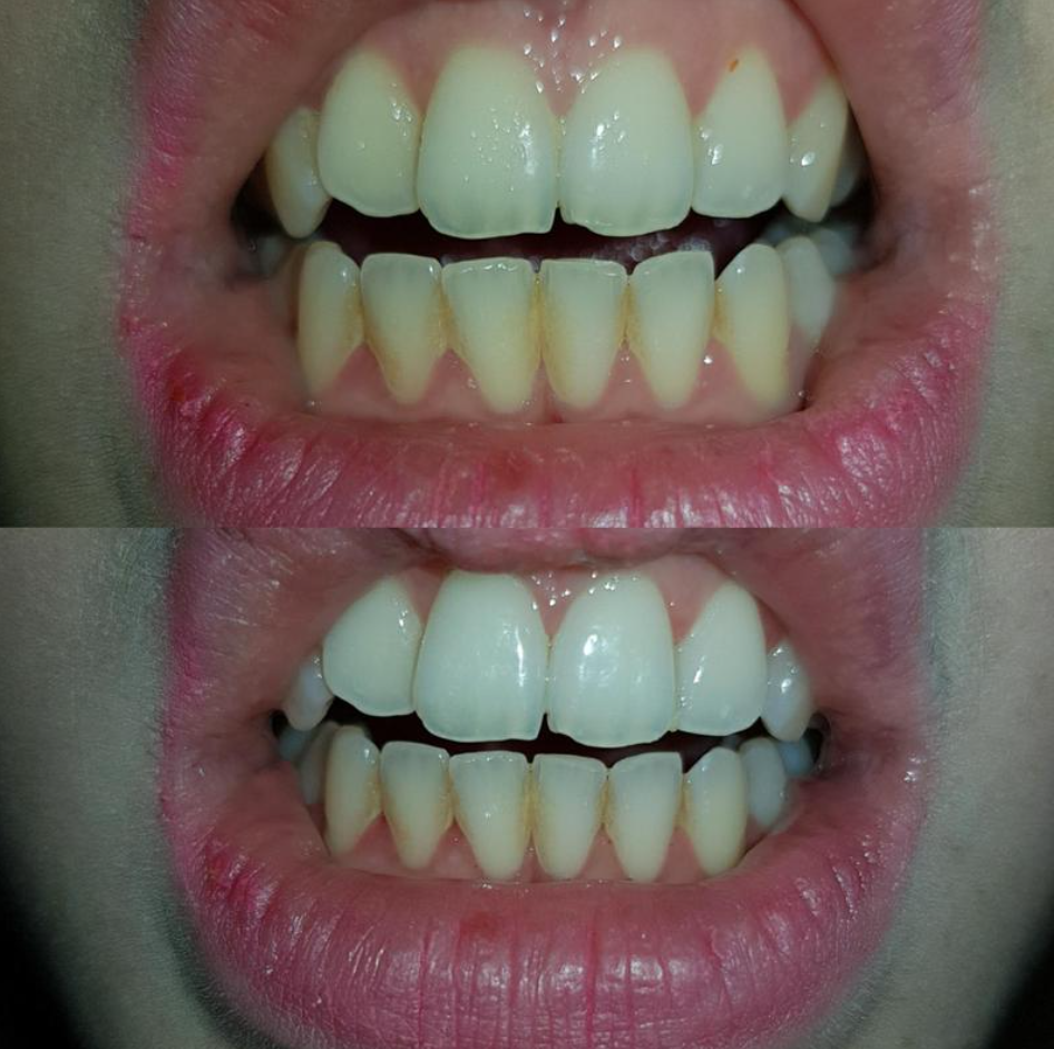 Kem đánh răng than hoạt tính Superdrug Charcoal Toothpaste - Đen (thường) 75ml