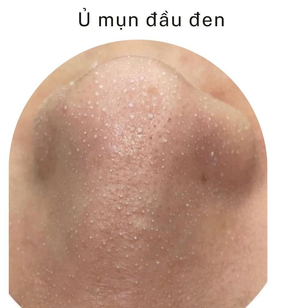 Ủ mụn đầu đen Removes BlackHeads ONMACABIM 60ml
