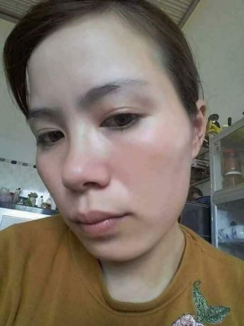 Bộ Kem Nám Vick White Beck ( trắng da mờ nám)