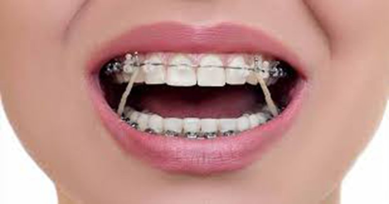 Combo 2 cái dụng cụ kéo thun liên hàm chỉnh nha