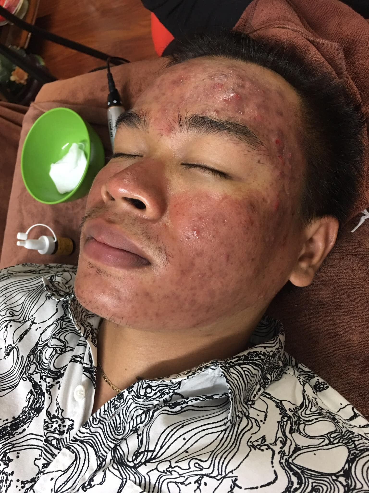 Serum Trị Mụn Thâm - Retinol/AHA/BHA DNA Cá Hồi