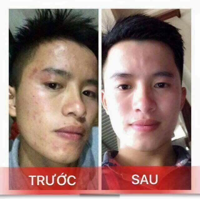 Kem Ngăn Ngừa Mụn Acne