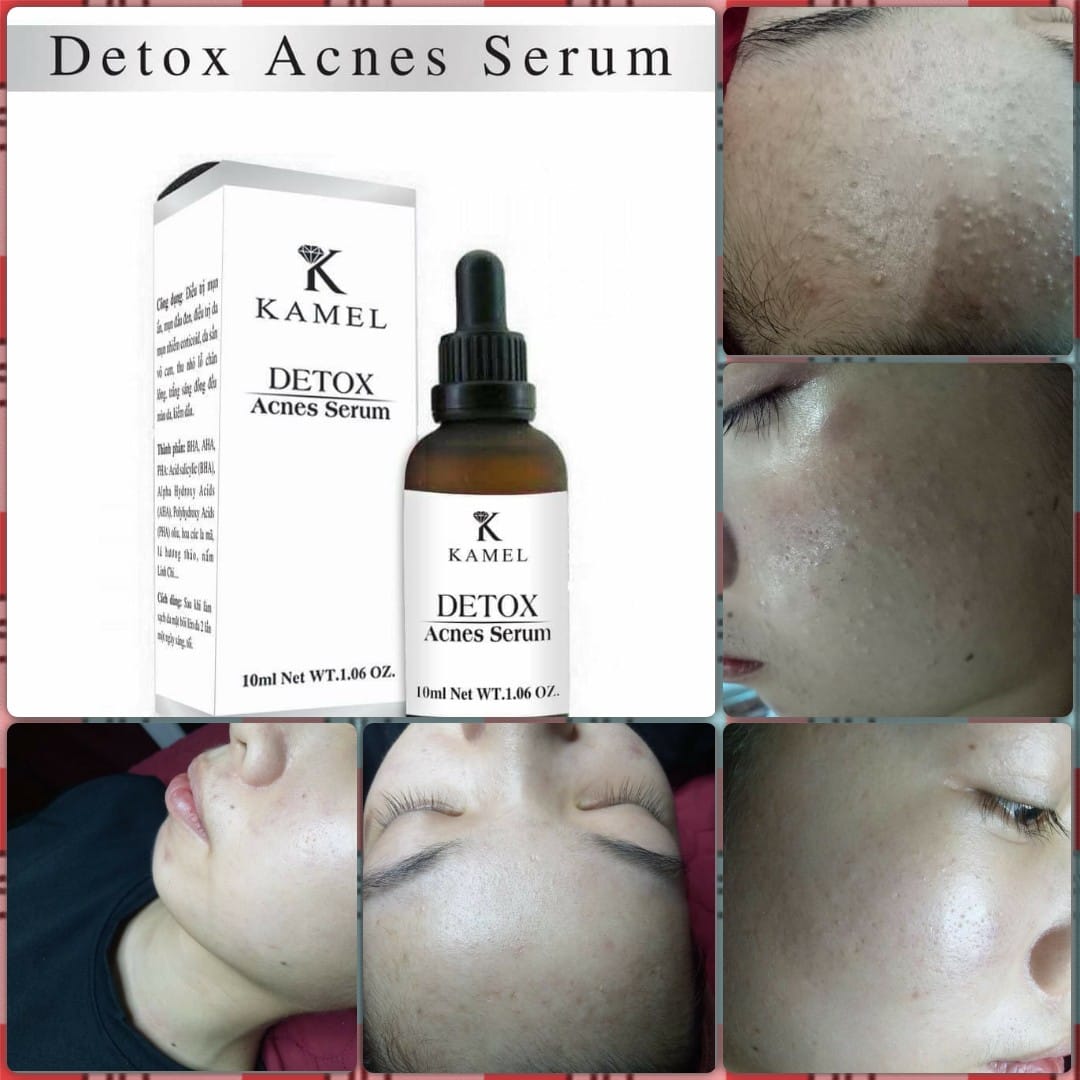 SERUM TRỊ MỤN KAMEL DETOX ACNES