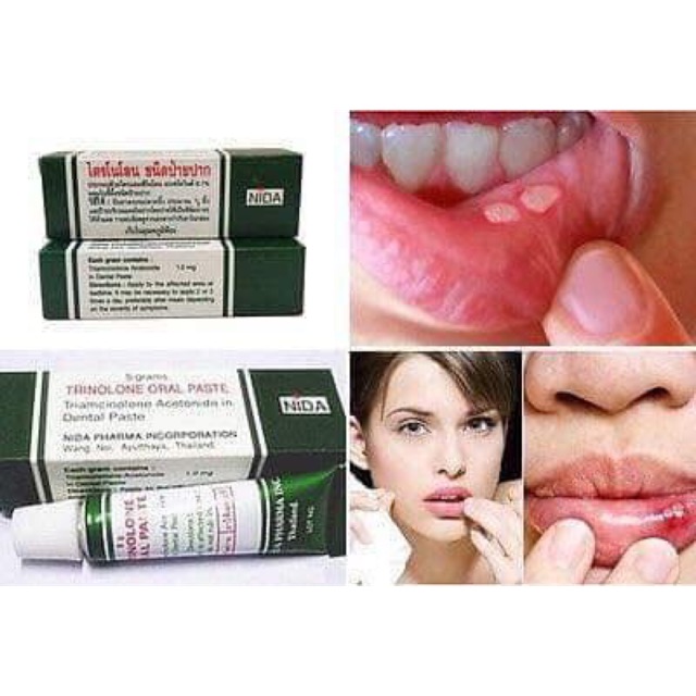 Kem Bôi Nhiệt Miệng TRINOLONE ORAL PASTE