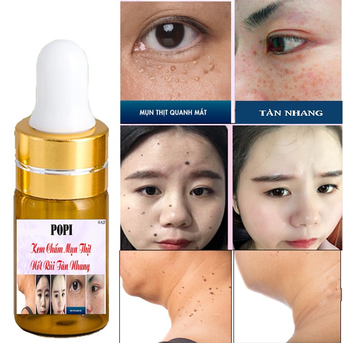 [HCM]Kem Xóa Nốt Ruồi Tàn Nhang Đồi Mồi