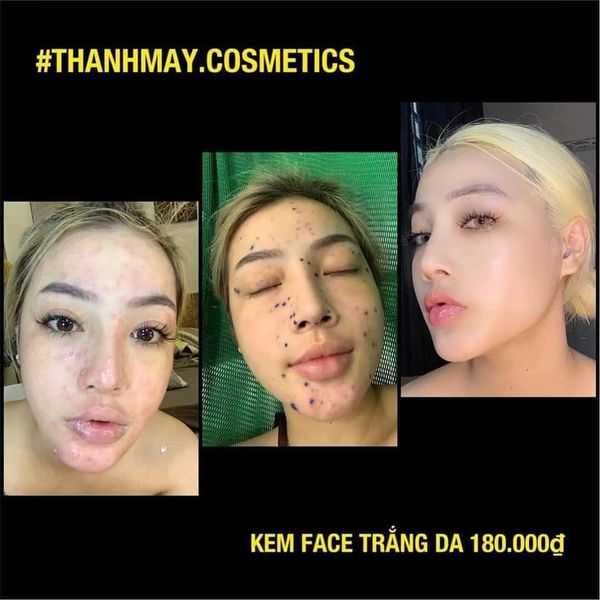 KEM FACE MÂY CREAM - MÂY CREAM ( PHIÊN BẢN CHO DA MỤN THÂM )(Tặng Tẩy Tế Bào Chết)