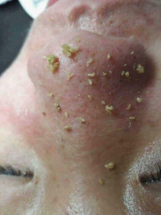 Tinh chất ủ mụn đầu đen, ủ mụn cám Youngerc