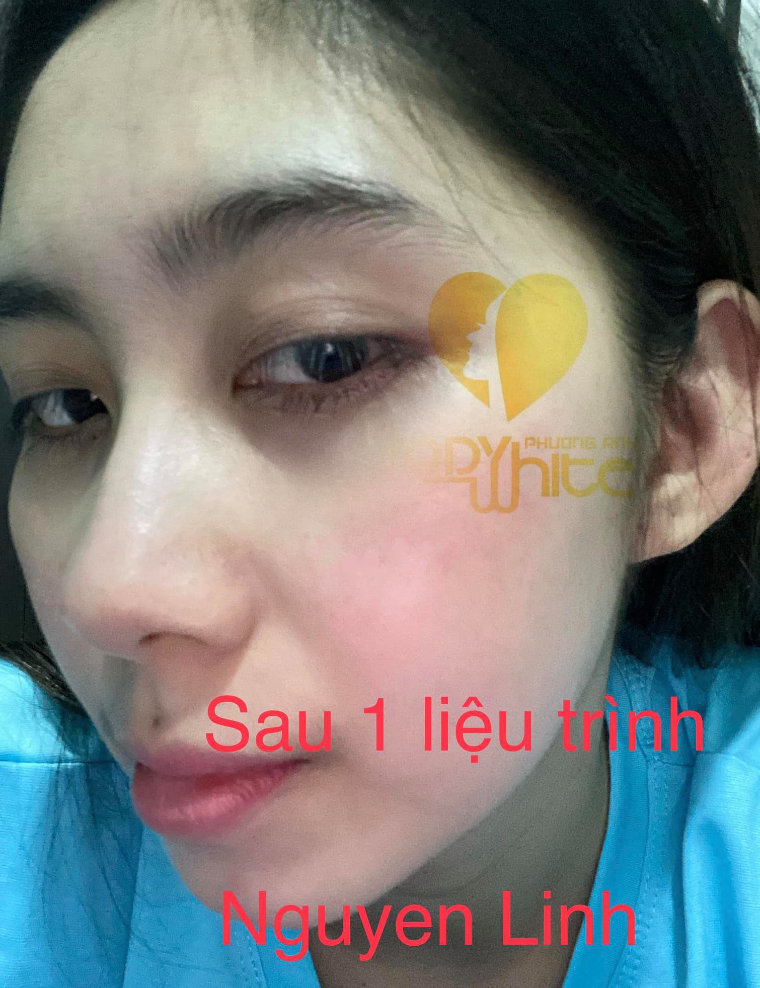 [TẶNG ẤM SIÊU TỐC +CHAI NƯỚC HOA PHÁP 20ML]-COMBO CHẤM TÀN NHANG,MỤN THỊT,MỤN RUỒI,MỤN CÓC 7 NGÀY BONG