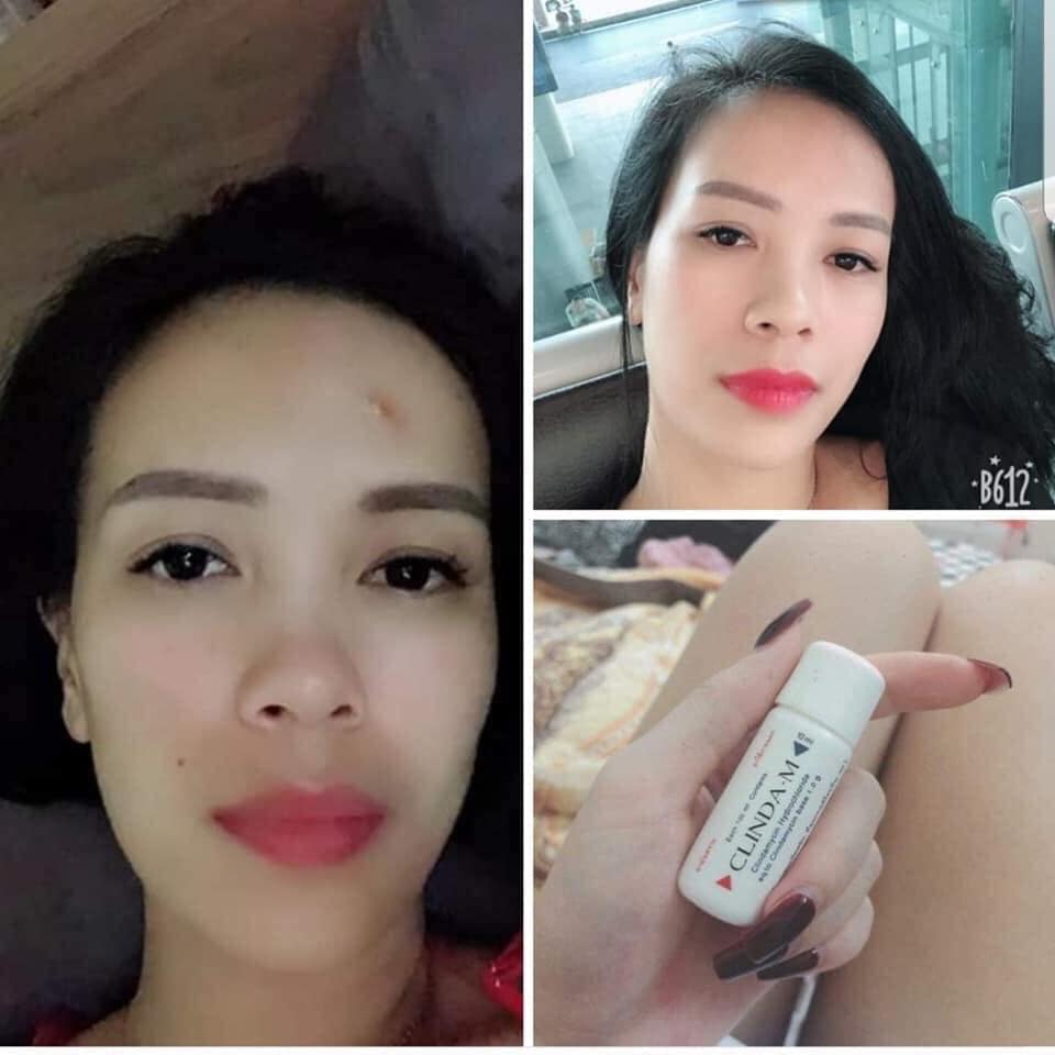 Serum chấm mụn Clinda M 15ml THÁI LAN