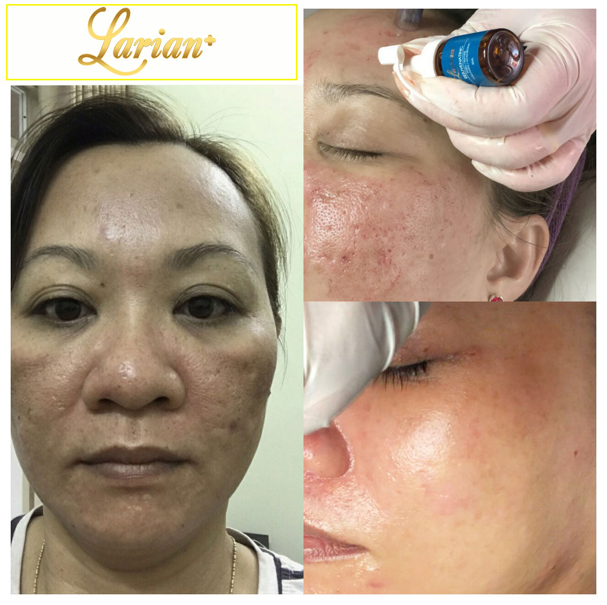 Rejuvenating DNA Serum ( Trị mụn - Nám - Sẹo rỗ)