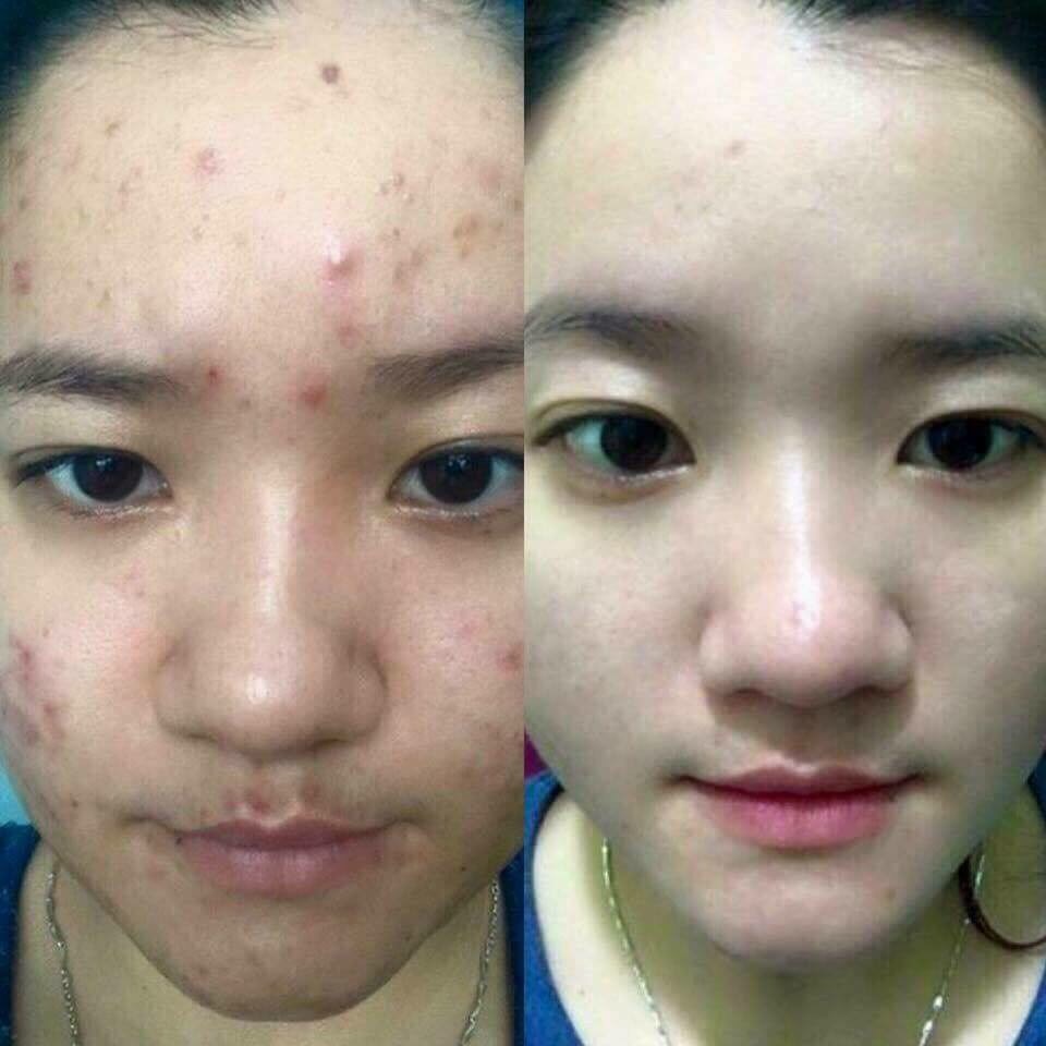 Kem Ngăn Ngừa Mụn Acne Dr Cell 30g dưỡng trắng mờ thâm mụn giảm mụn ngăn ngừa mụn