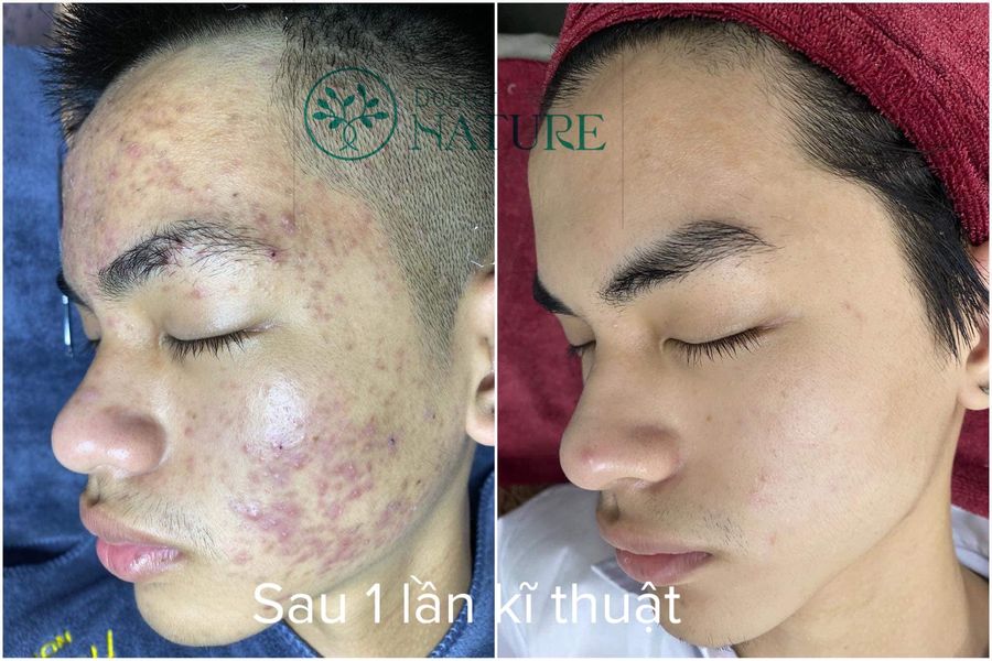 SERUM DETOX MỤN DOCTOR QUEEN -(MAU MOI)