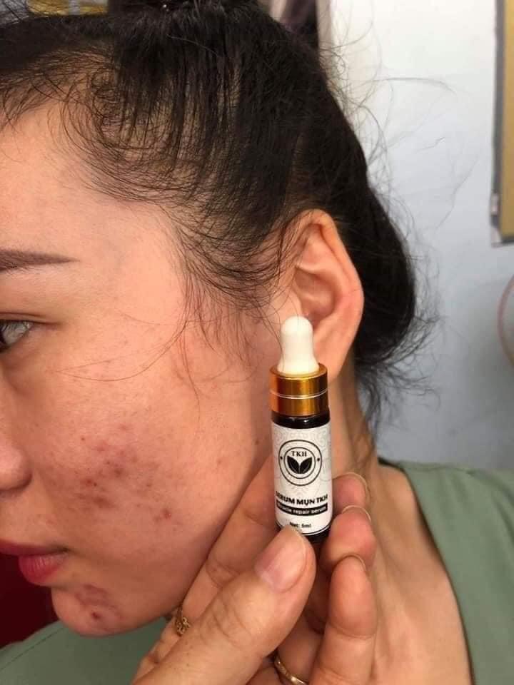 Serum Mụn Trần Kim Huyền Tkh