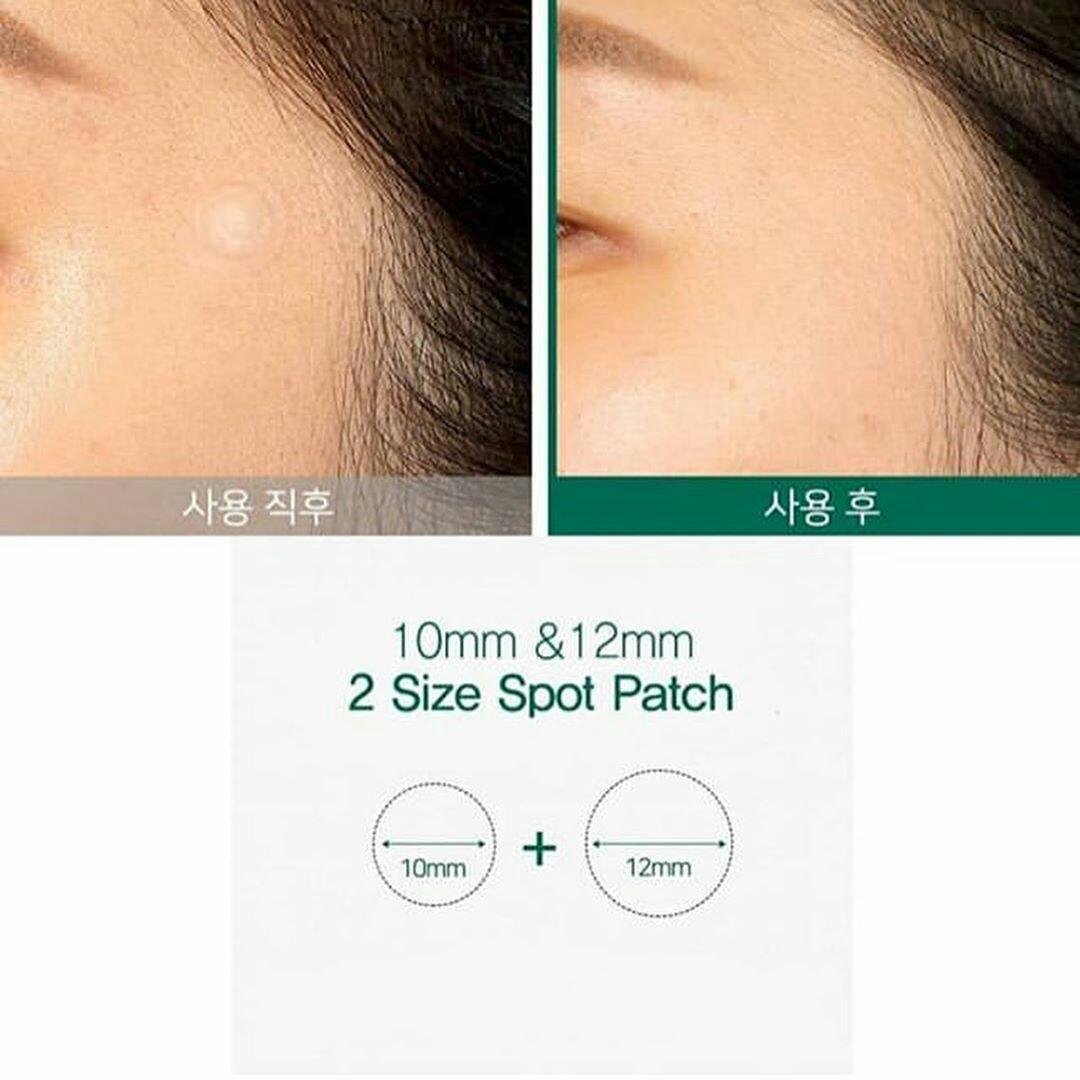 [HCM]Miếng Dán Giảm Mụn Some By Mi Clear Spot Patch Set 18 Miếng