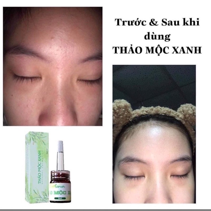 Serum Thảo Mộc Xanh Hàng Chính Hãng