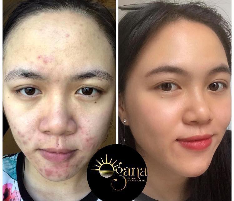 [HCM]SERUM OGANA TRỊ MỤN