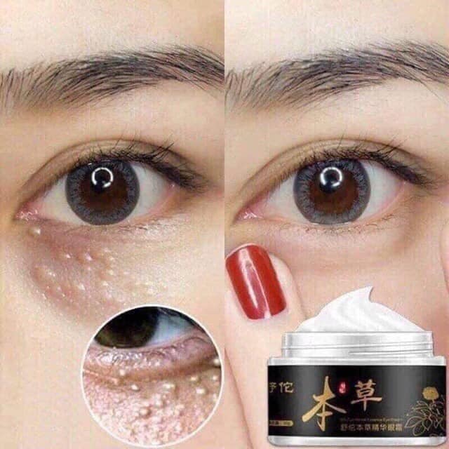 KEM ĐẶC TRỊ MỤN THỊT GENTITAN