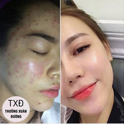 Kem Mụn Hoa Đào Hổ Trợ Cải Thiện Mụn, Thâm, Dưỡng Trắng Da