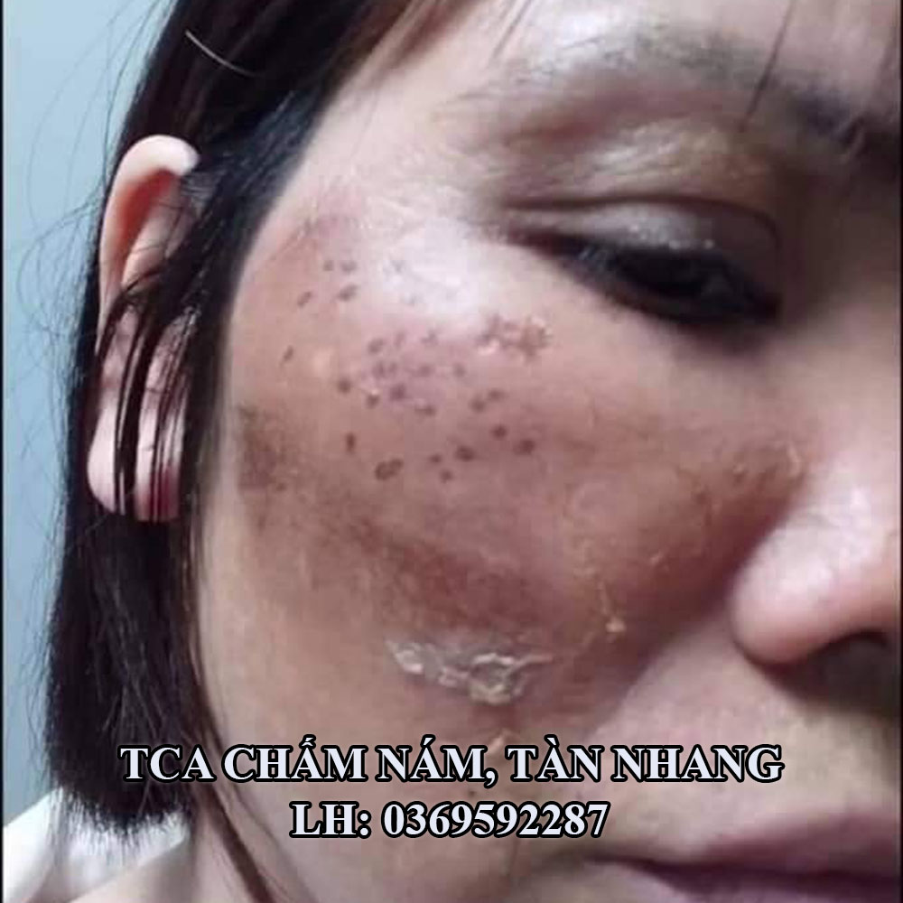 Chấm nám, tàn nhang, làm đầy sẹo rỗ Đức Thịnh 1ml Handmade