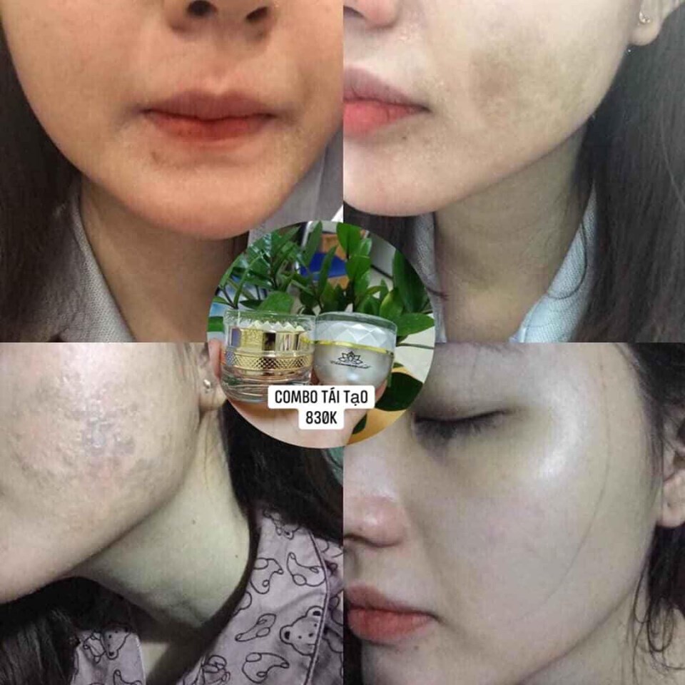 [HCM]KEM CHAMOMILESKILL CHÍNH HÃNG
