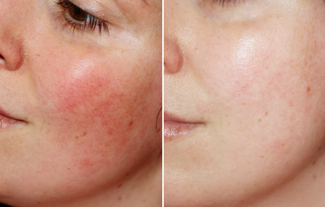 [B5 Mediphar] Serum dưỡng ẩm, cấp nước, phục hồi da MEDIPHAR+ HYDRATING B5