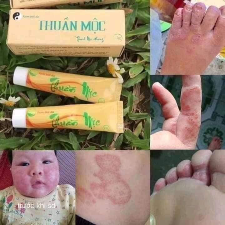 Kem bôi da trị ngứa Thuần Mộc