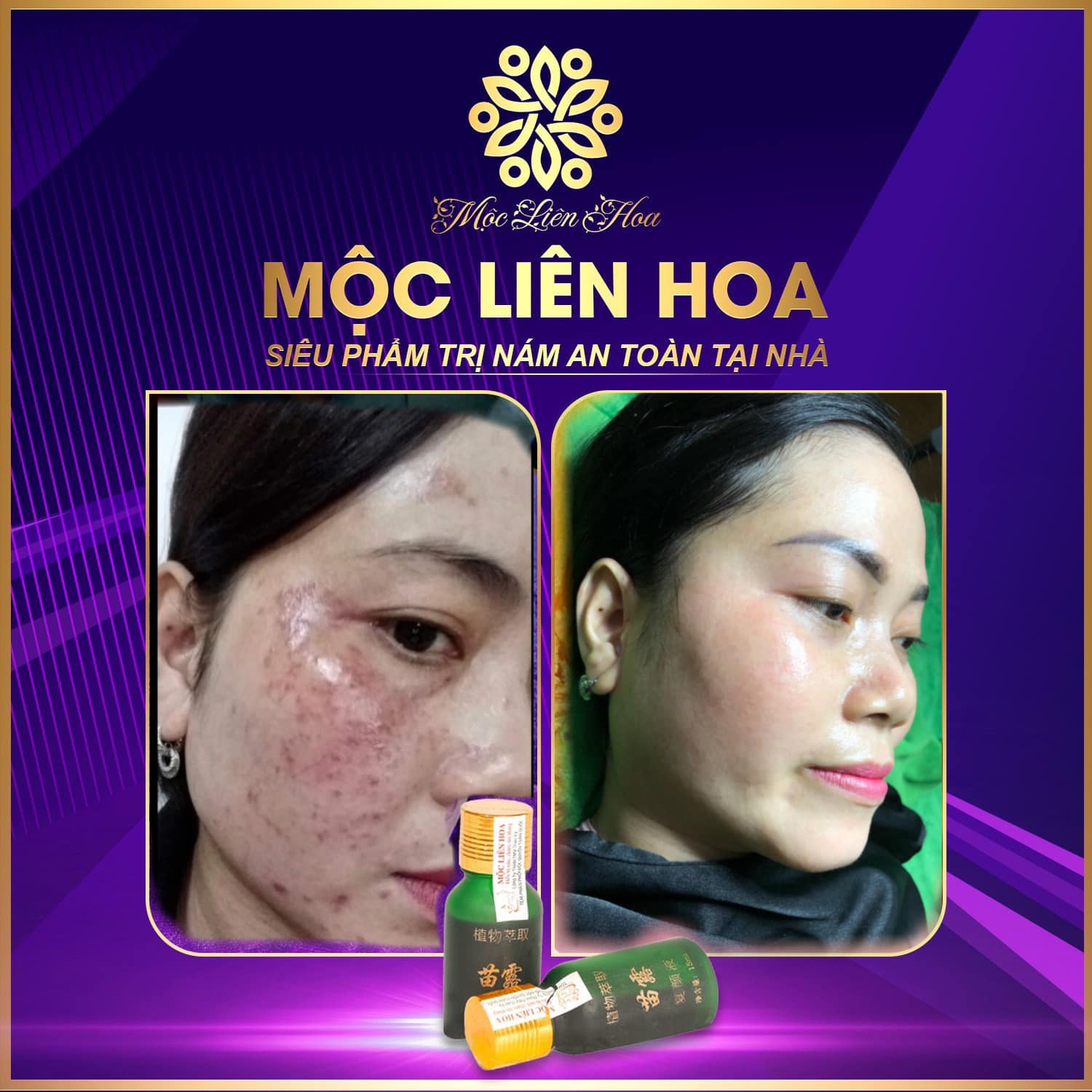 Serum đào thải sắc tố Mộc Liên Hoa
