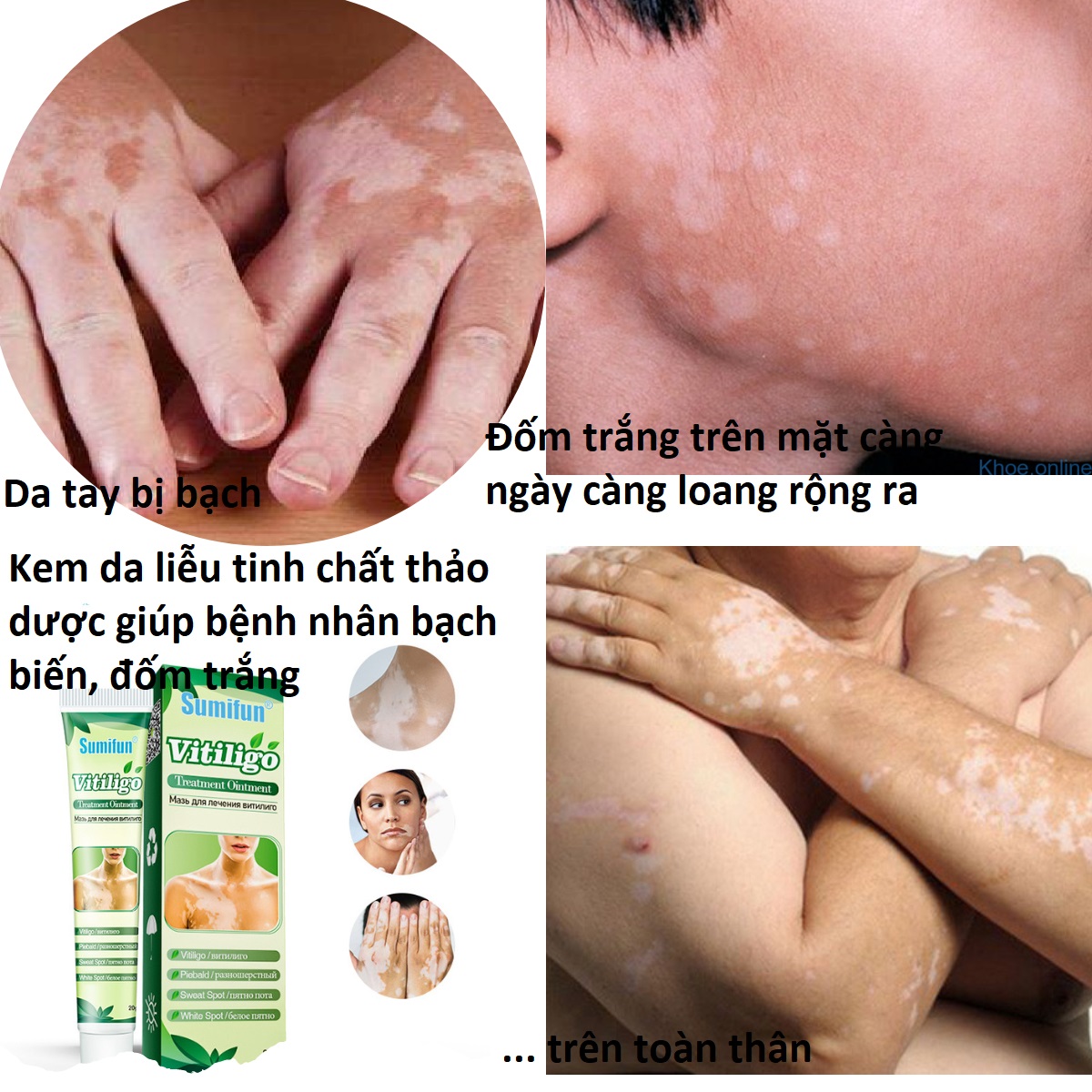 Kem bôi da bạch biến đốm trắng, thành phần thảo dược tự nhiên