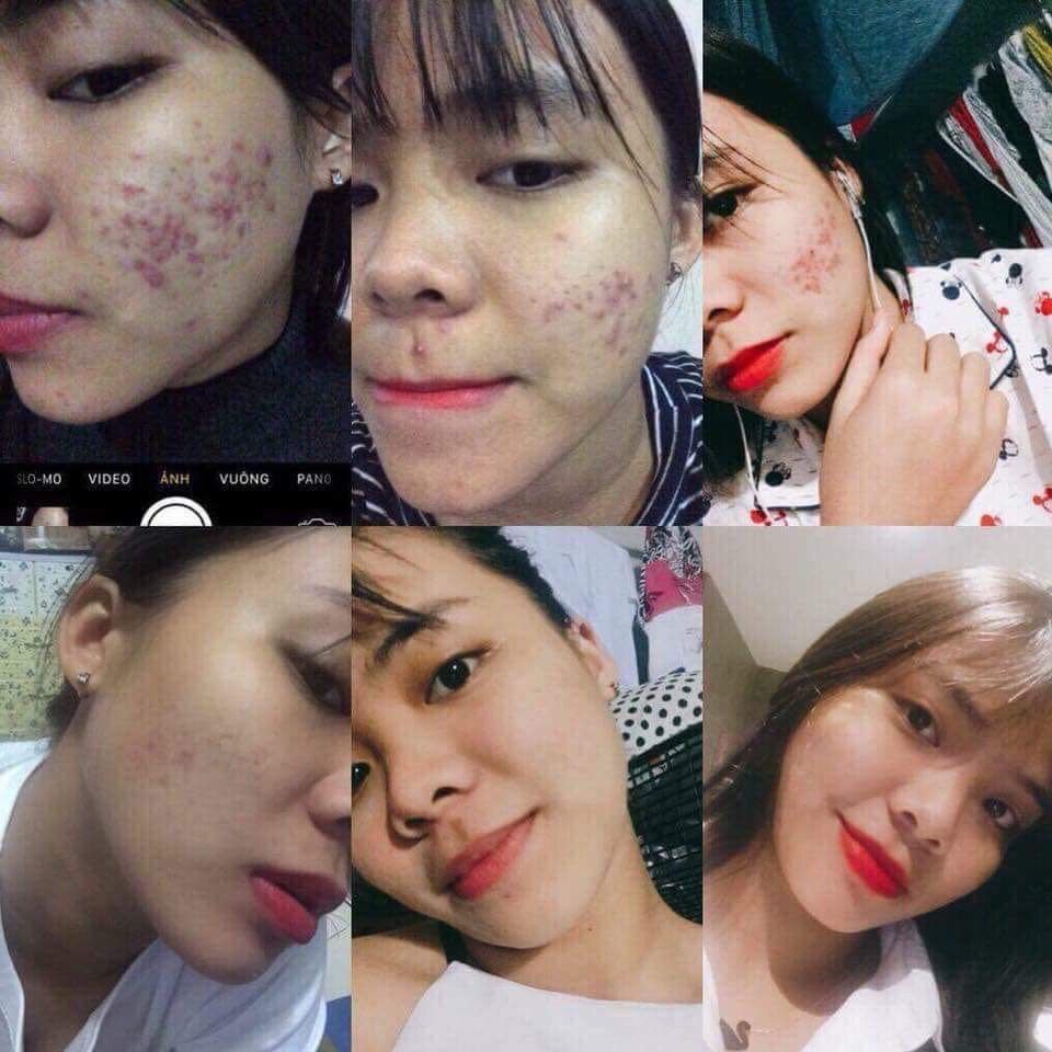COMBO TÁI TẠO DA ( Tạm biệt mụn )