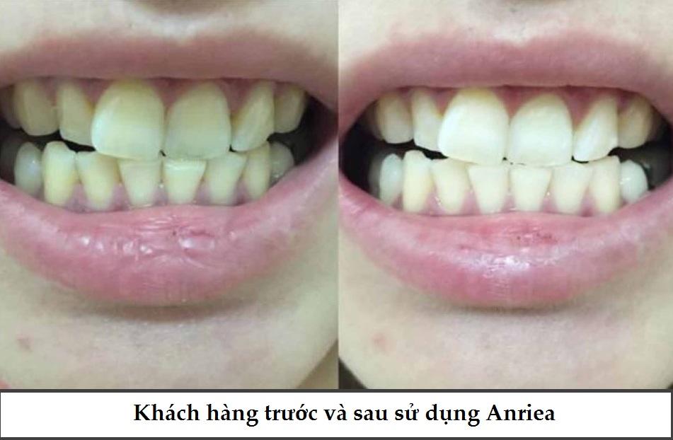 [Miếng lẻ] Miếng Dán Trắng Răng Anriea Black Tooth Whitening - 30 Minutes Express