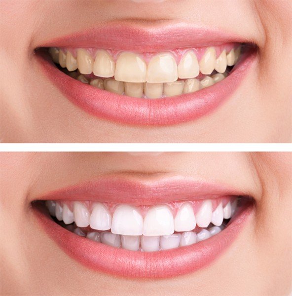 Kem đánh răng Crest 3D White Advanced Whitening 147g