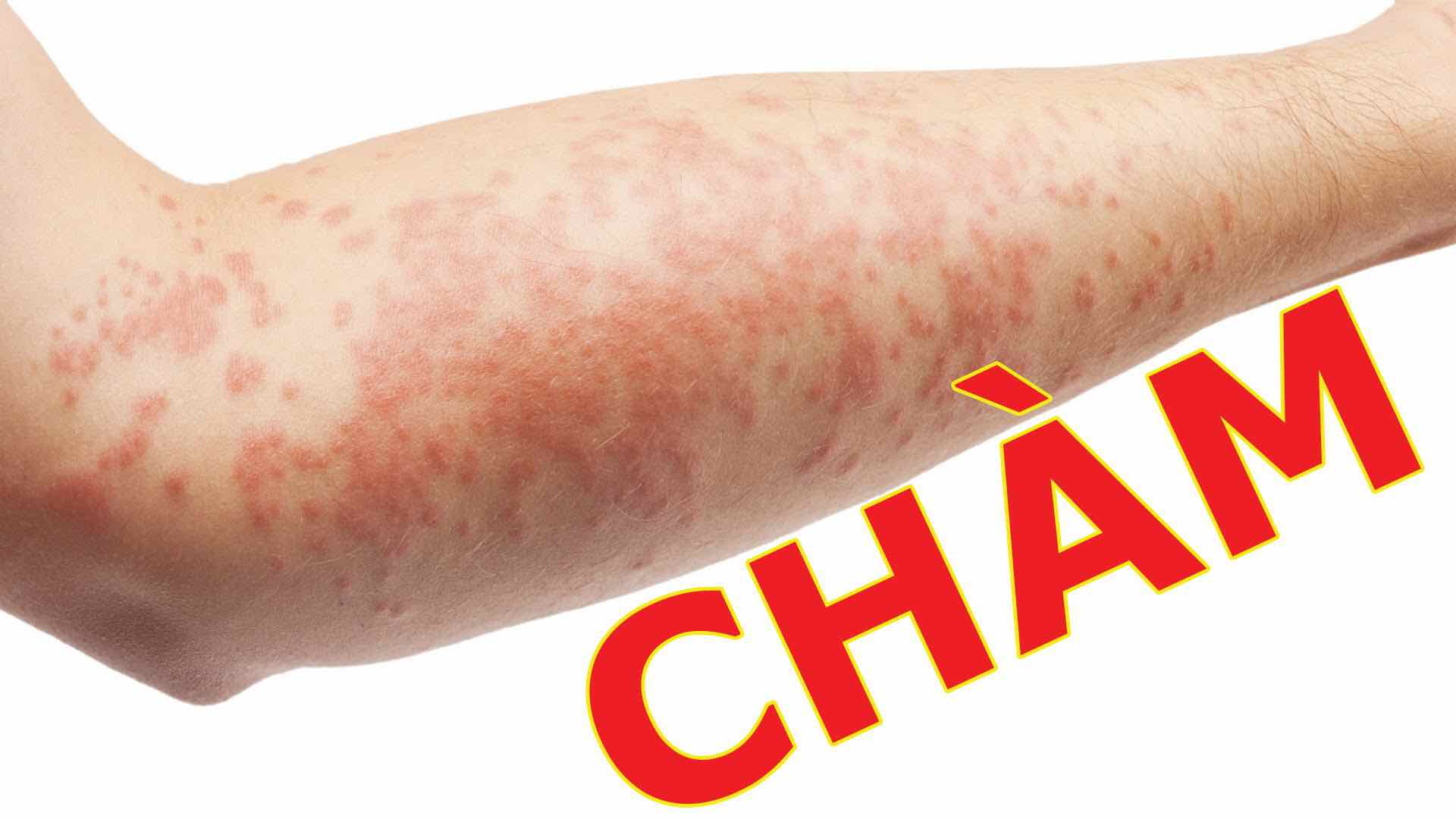 Kem nẻ chàm viêm da Dexeryl 50g MẪU MỚI
