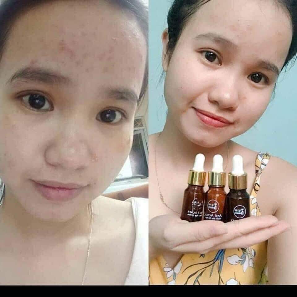 Serum Mụn MyMiu