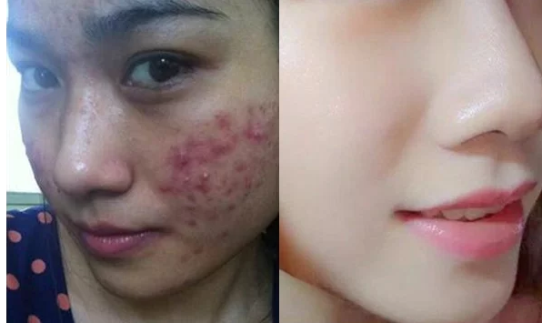 Serum tri Mụn Bọc tận gốc  Doctor Care