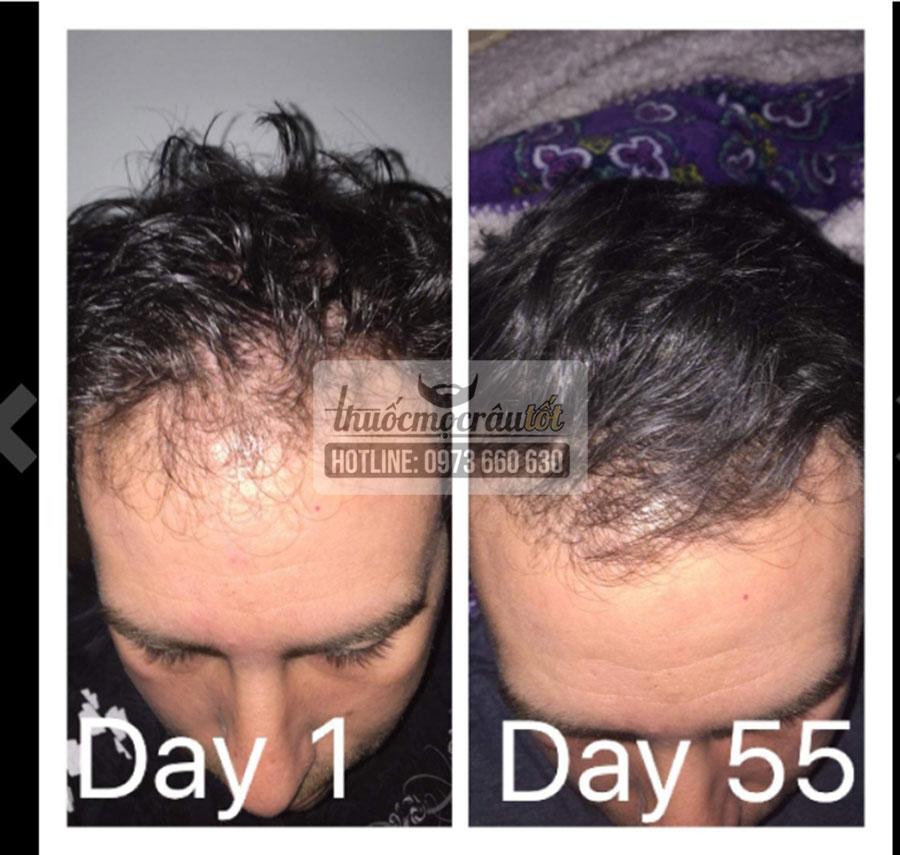 [HCM]Thuốc mọc tóc Mỹ hãng Kirkland