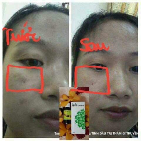 TINH DẦU TRI THÂM GIA TRUYỀN